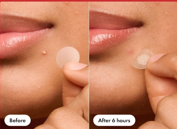 Overnigh pimple patch